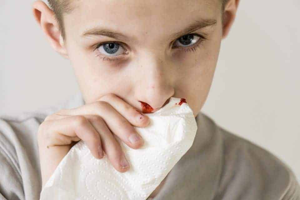 Nasenbluten bei Kindern – wie können Eltern helfen?