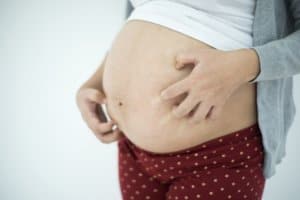 Schwangerschaftsdermatosen. Hautkrankheiten in der Schwangerschaft