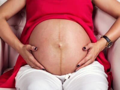 Linea nigra - dunker Streifen auf dem Babybauch