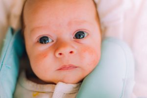 Hitzepickel beim Baby: Ursachen & Hausmittel die helfen